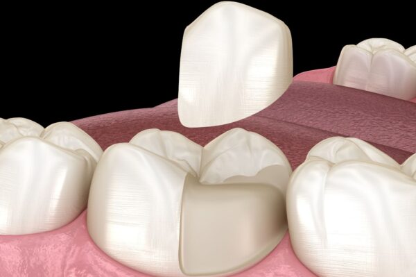 Tooth Onlay Process Inlays & Onlays