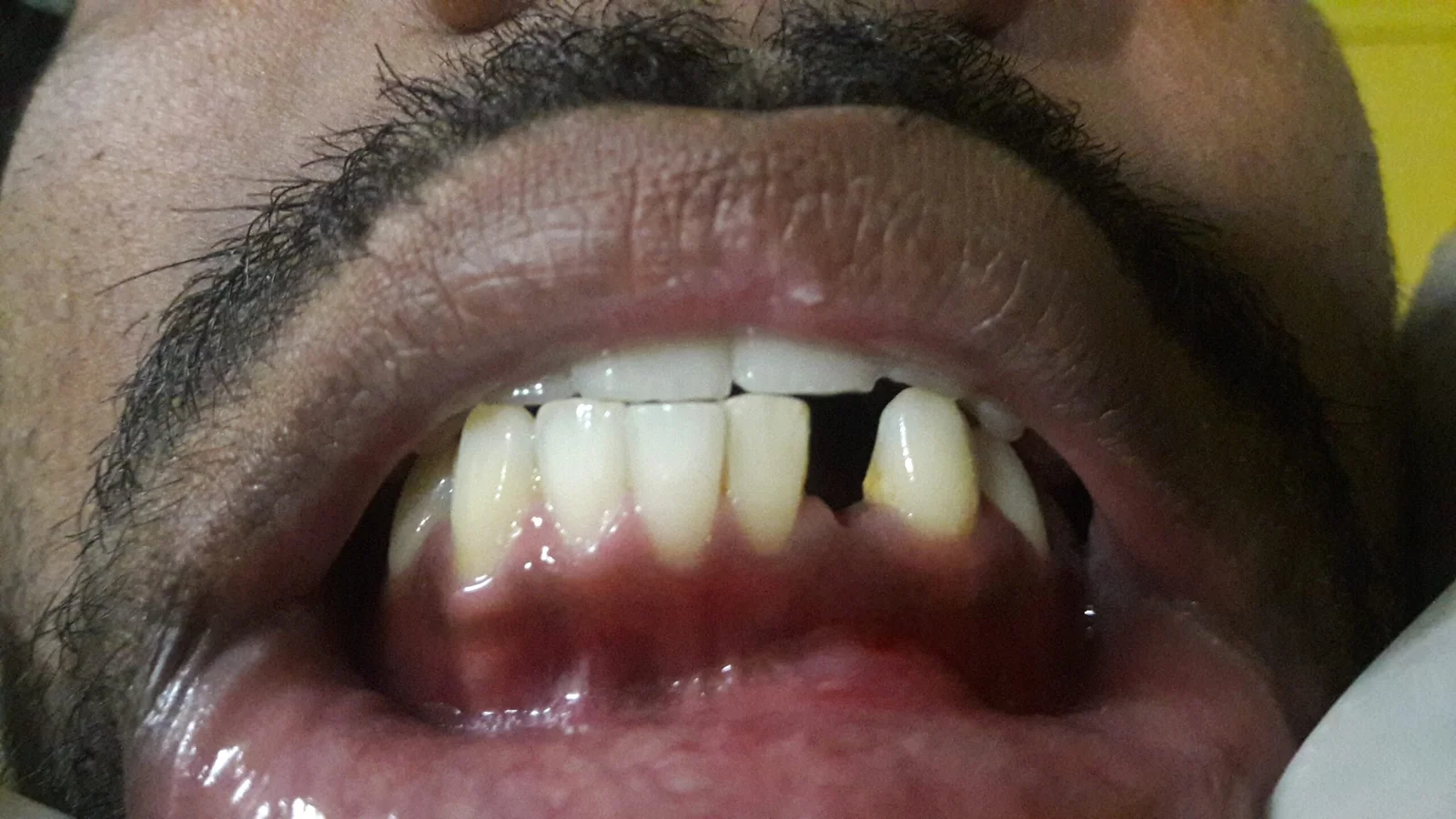 before-2